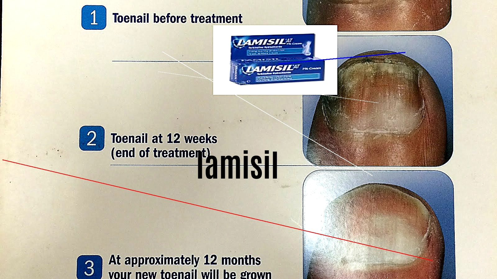 Lamisil en vente libre